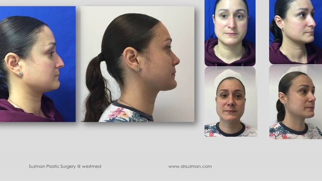 Dr. Suzman rhinoplasty with ch